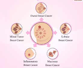 早期淋巴结阴性乳腺癌 前哨淋巴结活检与否不影响5年复发率​