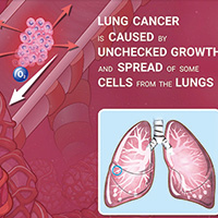 局部晚期NSCLC 同步化放疗时采用IMRT有更好的持久疗效